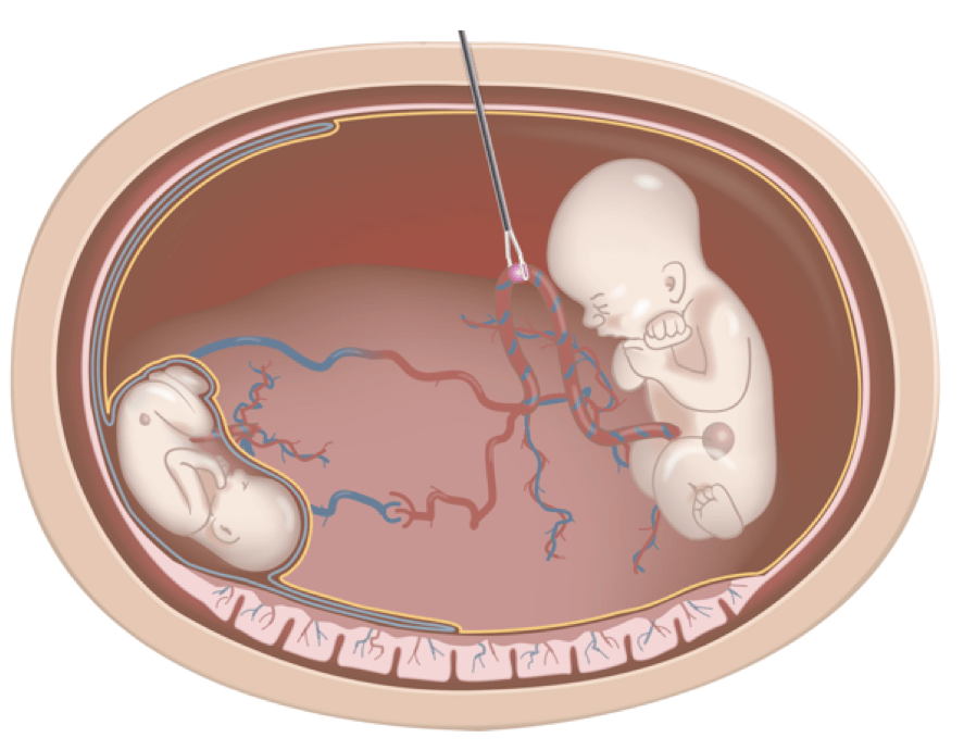 Feto Fetal Transfusion Syndrome El Síndrome de Transfusión Feto Fetal (II): Pronóstico, tratamiento y
